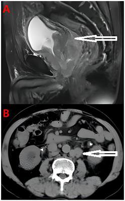 Multi-protocol exploratory treatment for metastatic castration-resistant prostate cancer with BRCA mutations: a case report and literature review